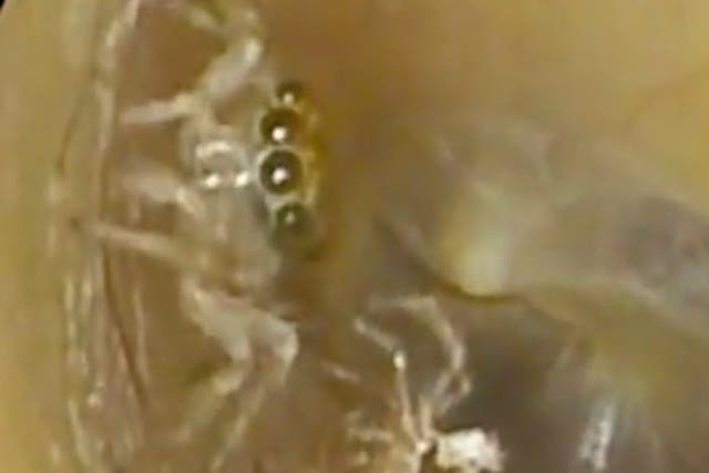 <p>Moment doctor discovers tiny spider living deep inside woman’s ear.</p>